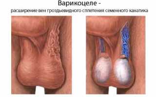 Варикоцеле: описание болезни