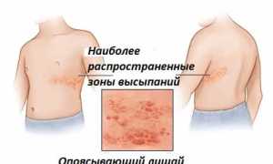 Опоясывающий герпес — обзор болезни