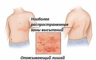 Опоясывающий герпес — обзор болезни