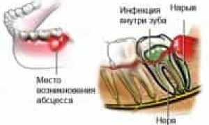 Абсцесс зуба — обзор болезни