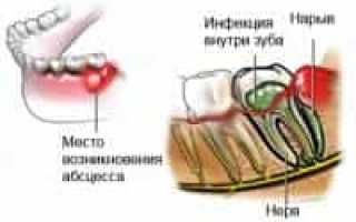 Абсцесс зуба — обзор болезни