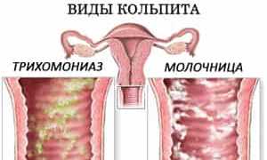 Виды кольпита