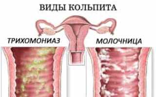Виды кольпита