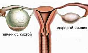 Киста яичника — обзор болезни