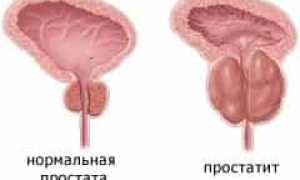 Простатит – способы лечения