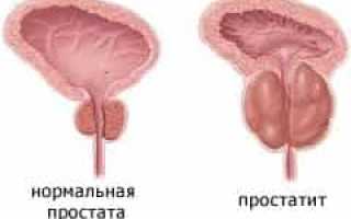 Простатит – способы лечения