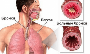 Бронхит — причины, симптомы, и лечение