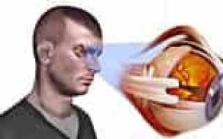 Что происходит при глаукоме?