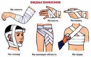 Правила наложения повязок и их разновидности