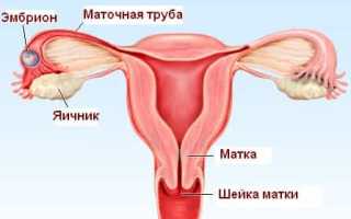 Что такое внематочная беременность? Обзор болезни