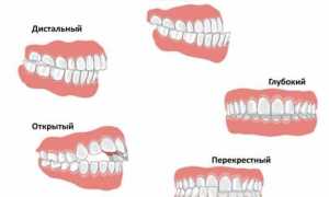Неправильный прикус: причины, симптомы, лечение