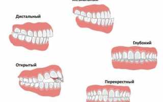 Неправильный прикус: причины, симптомы, лечение
