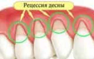 Причины рецессии десны, и как ее остановить?