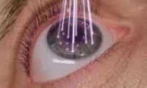 Лазерная коррекция зрения LASIK: какой из эксимерных лазеров лучше?