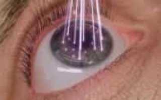 Лазерная коррекция зрения LASIK: какой из эксимерных лазеров лучше?