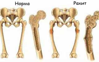 Рахит — обзор болезни