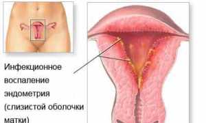 Метроэндометрит — обзор болезни