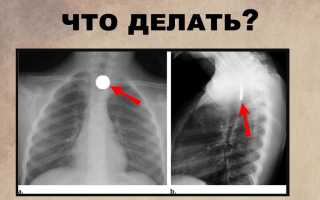 Что делать в случае, если ребенок проглотил стекло, монету или пуговицу?