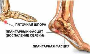 Помощь при боли в пятках