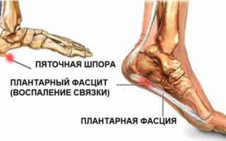Помощь при боли в пятках