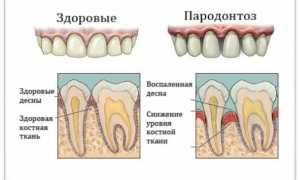 Пародонтоз: причины и предотвращение