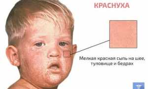 Краснуха — обзор болезни