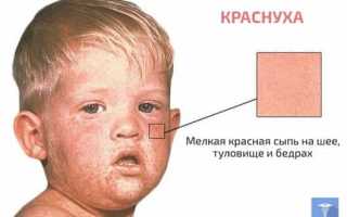 Краснуха — обзор болезни