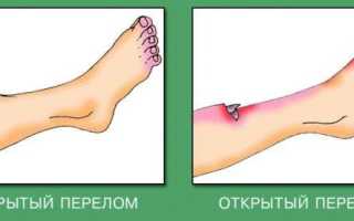 Эффективная первая помощь при переломе голени