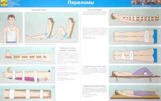 Что делать при переломе бедра до приезда скорой помощи?
