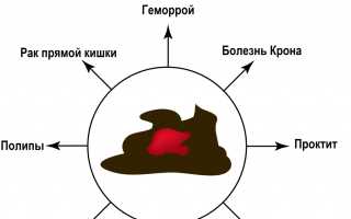 Причины, симптомы и лечение желудочно-кишечного кровотечения