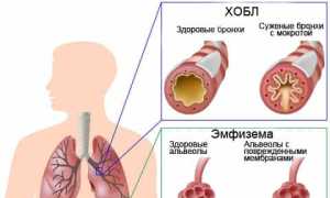 Связь ХОБЛ и пневмонии: факторы риска
