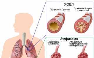 Связь ХОБЛ и пневмонии: факторы риска