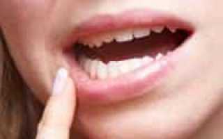 3 способа избавиться от стоматита быстро и в домашних условиях