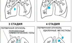 Симптомы 3 стадии рака лёгкого, и их особенности