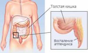 Аппендицит — обзор болезни