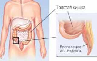 Аппендицит — обзор болезни