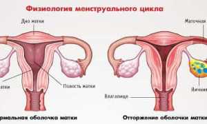 Аменорея — обзор болезни