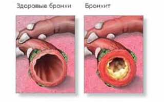 Что такое бронхит? Обзор темы