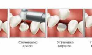 Что такое коронки и мосты в стоматологии?