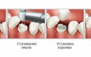 Что такое коронки и мосты в стоматологии?