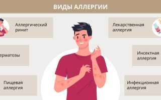 Проявление аллергической реакции. Как помочь себе в домашних условиях?