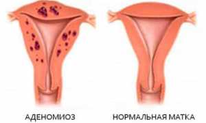 Что такое аденомиоз: типы, причины, симптомы, лечение