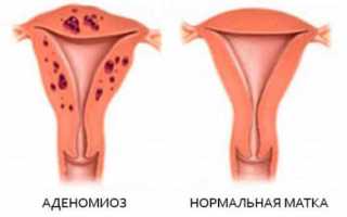 Что такое аденомиоз: типы, причины, симптомы, лечение