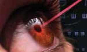 Риски и осложнения после процедуры LASIK