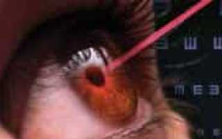Риски и осложнения после процедуры LASIK