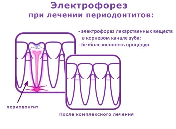 Электрофорез может применяться при лечении периодонтитов