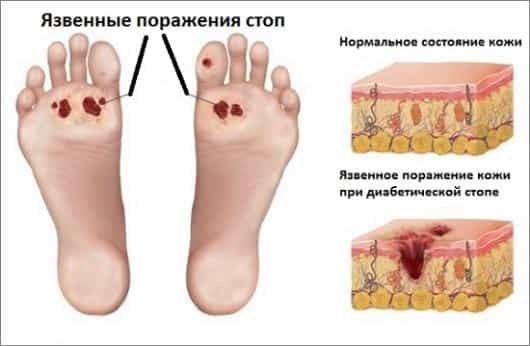 язвы на стопах