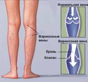 варикозное расширение вен