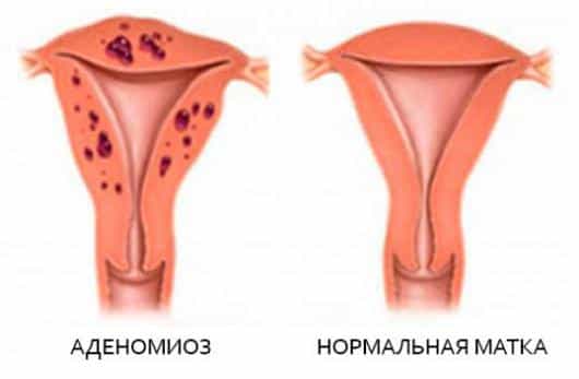 аденомиоз