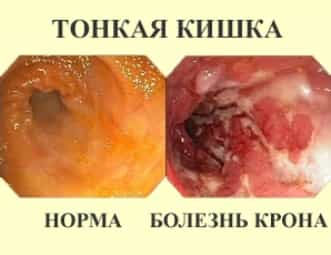анальный синдром крона